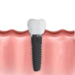 dental-implants-1636565